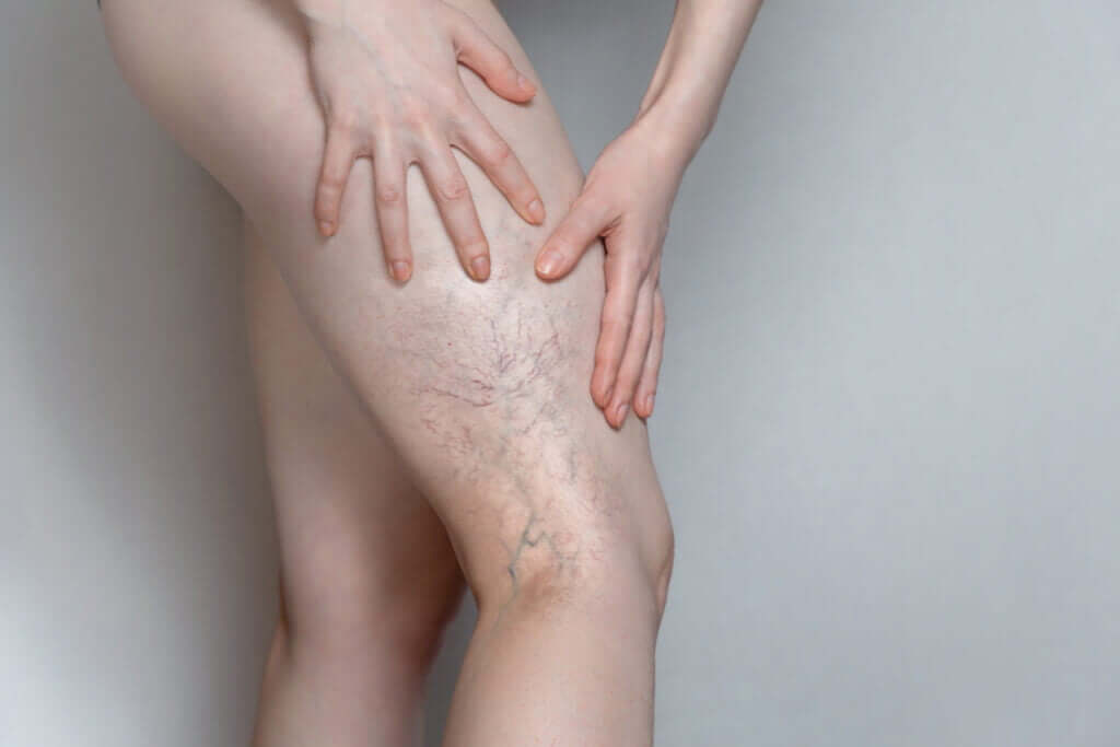 Spider Vein Treatment in Philadelphia, PA