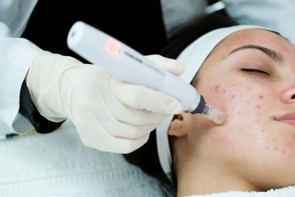 Microneedling in Philadelphia, PA