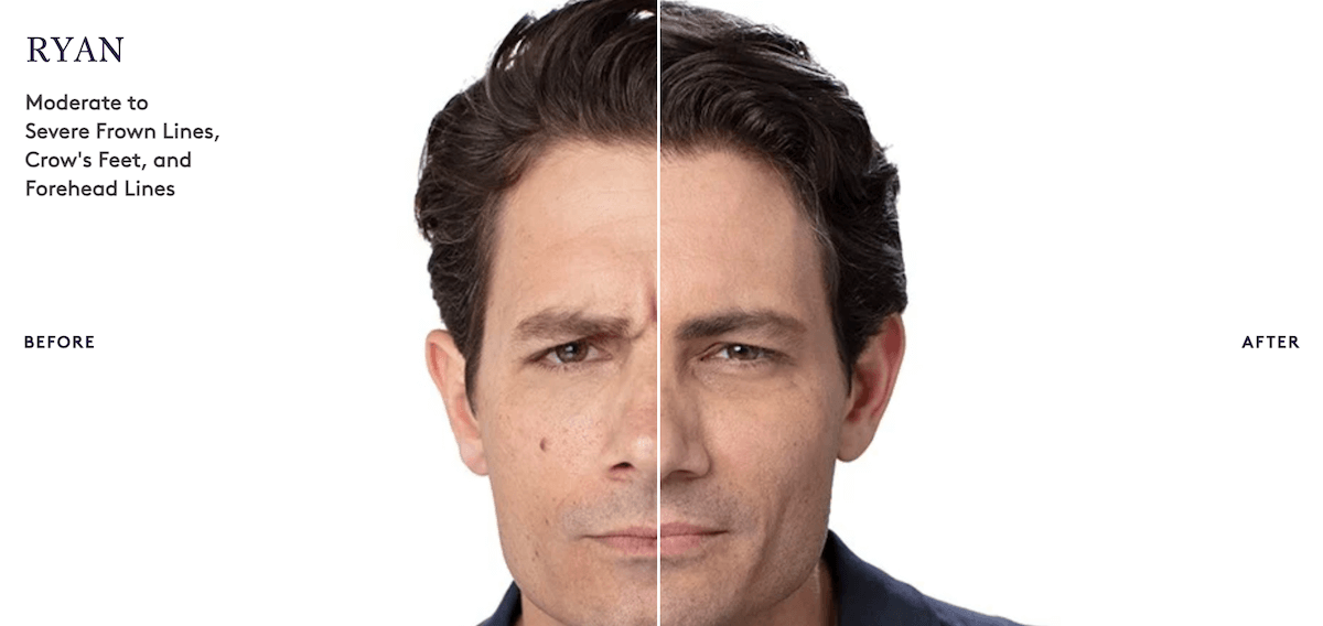 Botox® men Philadelphia