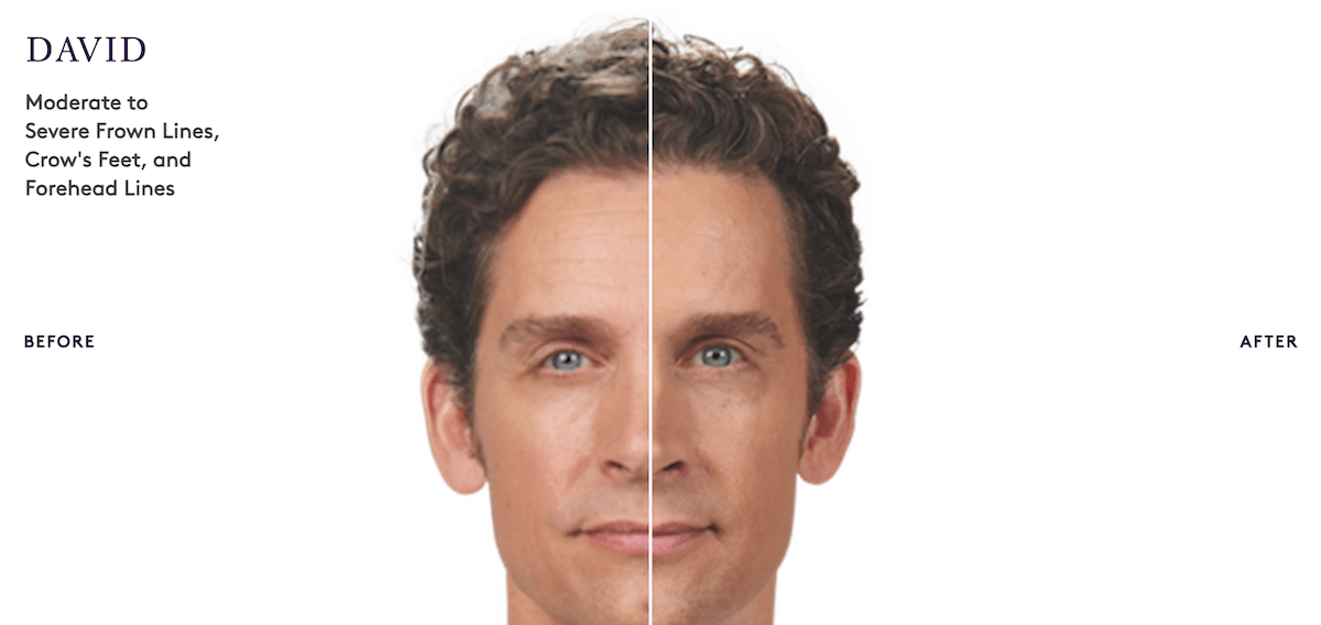 Botox® men Philadelphia