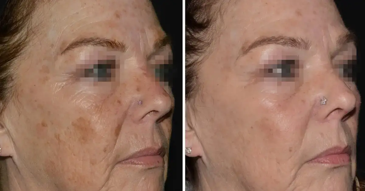 Lutronic LaseMD Ultra™ in Philadelphia, PA