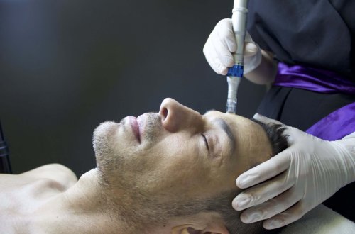 Microneedling w/ RF in Philadelphia, PA