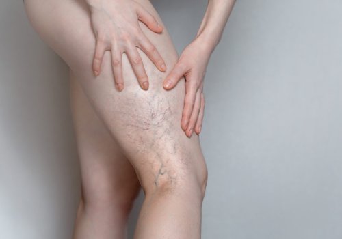 Spider Vein Treatment in Philadelphia, PA